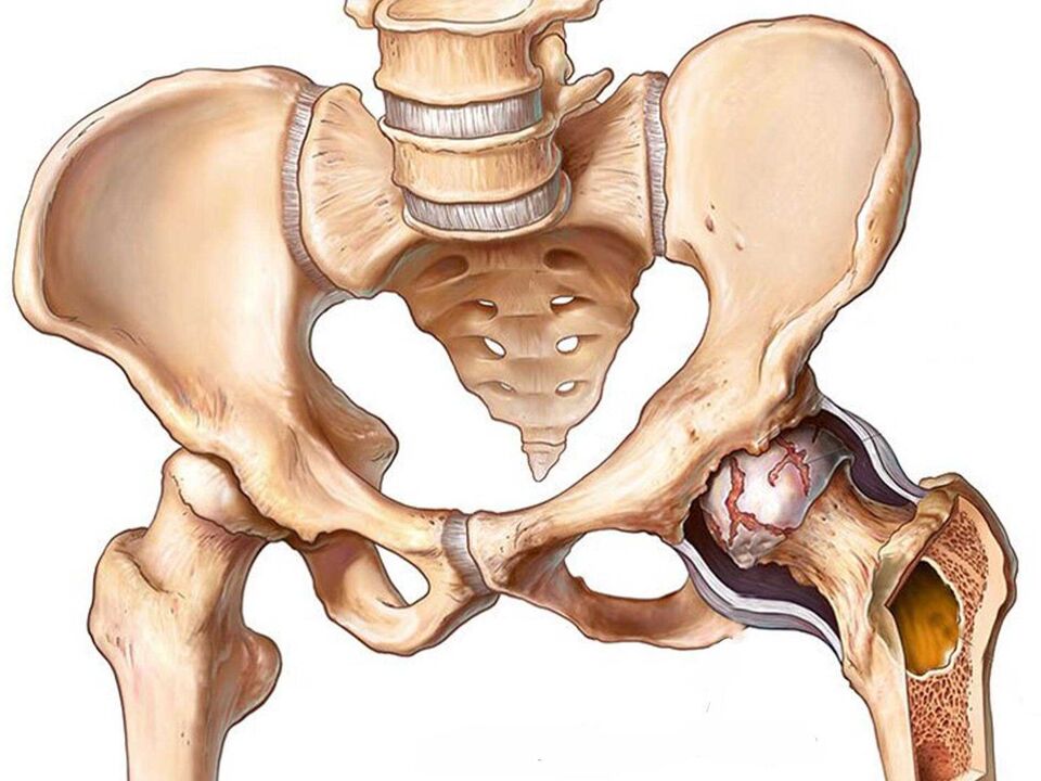 артроз тазобедренного сустава